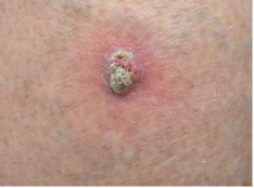 squamous cell carcinoma